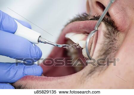 Stock Photography - Removing dental tartar. Fotosearch