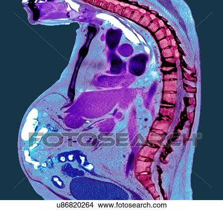 Spine in ankylosing spondylitis, X-ray View Large Photo Image Picture - Spine in ankylosing spondylitis, X-ray. Fotosearch