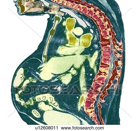 Stock Image - Spine in ankylosing spondylitis, X-ray. Fotosearch