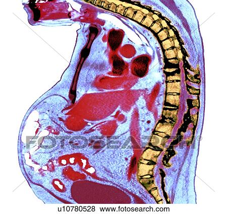 Stock Photo - Spine in ankylosing spondylitis, X-ray. Fotosearch