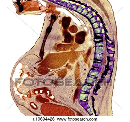 Stock Photograph - Spine in ankylosing spondylitis, X-ray. Fotosearch