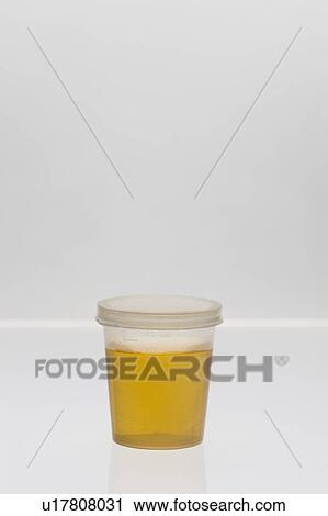 Stock Image - Urine sample in plastic cup.. Fotosearch