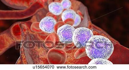 Acute lymphoblastic leukaemia, illustration View Large Photo Image Stock Image - Acute lymphoblastic leukaemia, illustration. Fotosearch