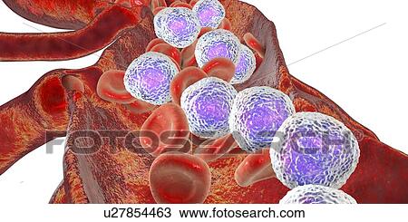 Stock Image - Acute lymphoblastic leukaemia, illustration. Fotosearch