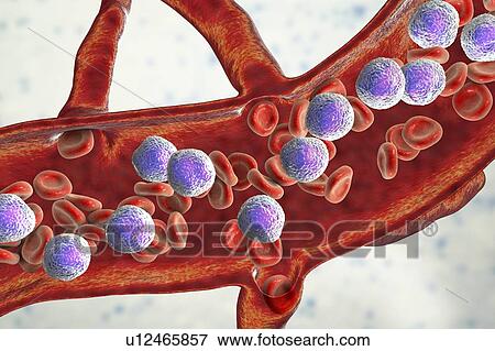 Stock Photo - Acute lymphoblastic leukaemia, illustration. Fotosearch