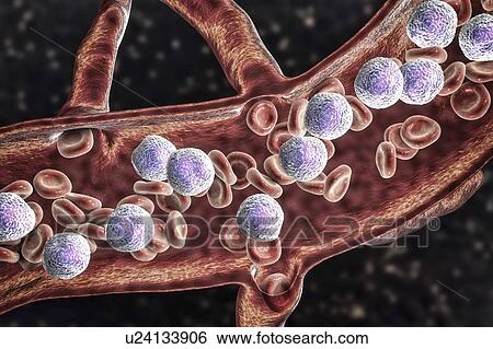 Acute lymphoblastic leukaemia, illustration View Large Photo Image Stock Photograph - Acute lymphoblastic leukaemia, illustration. Fotosearch