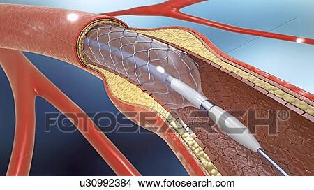 Picture - Arterial stent, illustration. Fotosearch