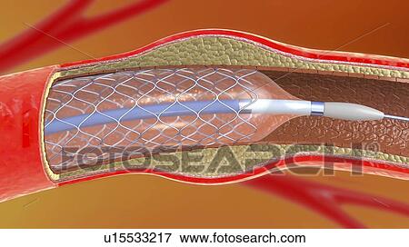 Arterial stent, illustration View Large Photo Image Stock Photo - Arterial stent, illustration. Fotosearch
