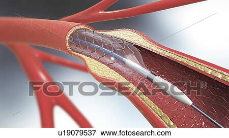 Stock Photo - Arterial stent, illustration. Fotosearch