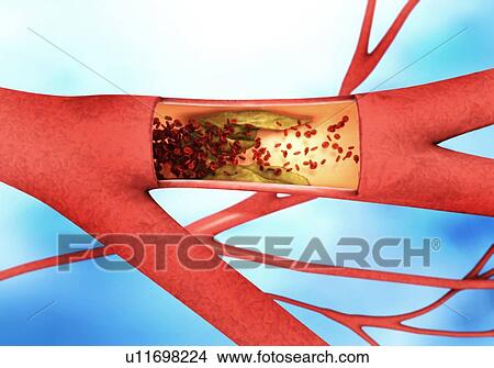 Atherosclerosis, illustration View Large Photo Image Picture - Atherosclerosis, illustration. Fotosearch