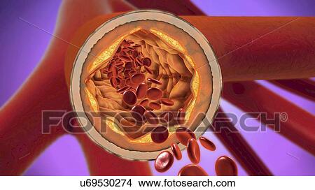 Picture - Atherosclerosis, illustration. Fotosearch