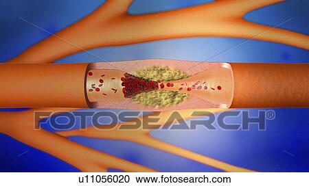 Stock Image - Atherosclerosis, illustration. Fotosearch