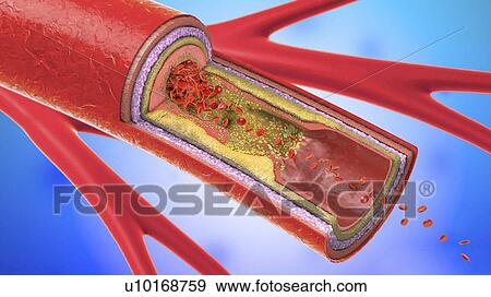 Stock Photo - Atherosclerosis, illustration. Fotosearch