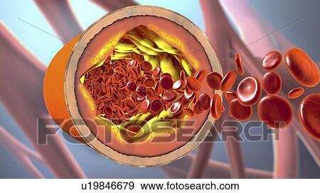 Stock Photo - Atherosclerosis, illustration. Fotosearch