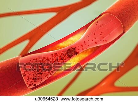 Stock Photo - Atherosclerosis, illustration. Fotosearch