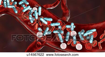 Stock Image - Bacterial blood infection, illustration. Fotosearch