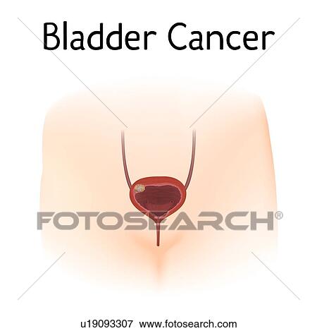 Stock Photo - Bladder cancer, illustration. Fotosearch