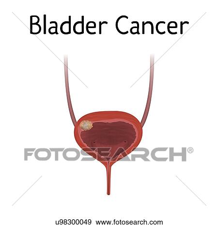 Bladder cancer, illustration View Large Photo Image Stock Photo - Bladder cancer, illustration. Fotosearch