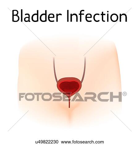 Stock Image - Bladder infection, illustration. Fotosearch
