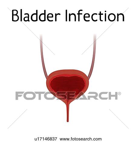 Stock Photo - Bladder infection, illustration. Fotosearch