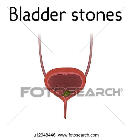 Stock Photograph - Bladder stones, illustration. Fotosearch