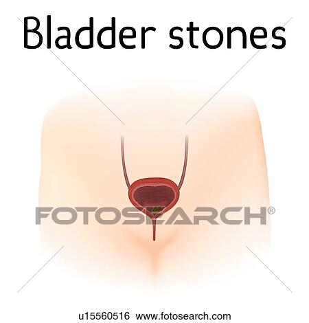 Bladder stones, illustration View Large Photo Image Stock Photograph - Bladder stones, illustration. Fotosearch