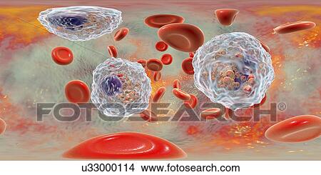 Picture - Blood smear with numerous eosinophils, illustration. Fotosearch