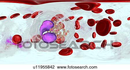 Stock Image - Blood smear with numerous eosinophils, illustration. Fotosearch