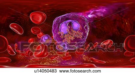 Stock Image - Blood smear with numerous eosinophils, illustration. Fotosearch