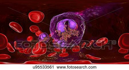 Stock Image - Blood smear with numerous eosinophils, illustration. Fotosearch