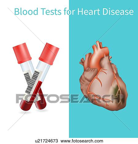 Stock Image - Blood tests for heart disease, illustration. Fotosearch