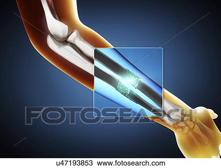 Stock Image - Broken arm, illustration. Fotosearch