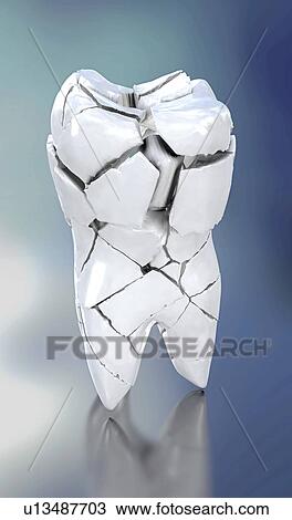 Stock Image - Broken tooth, illustration. Fotosearch