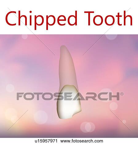 Chipped tooth, illustration View Large Photo Image Stock Image - Chipped tooth, illustration. Fotosearch