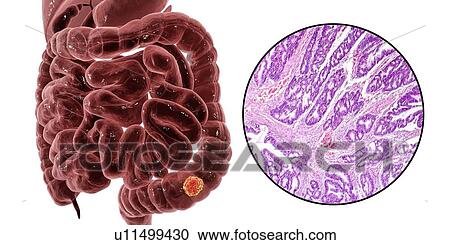 Stock Image - Colon cancer, composite image. Fotosearch