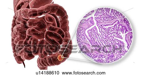 Stock Image - Colon cancer, composite image. Fotosearch