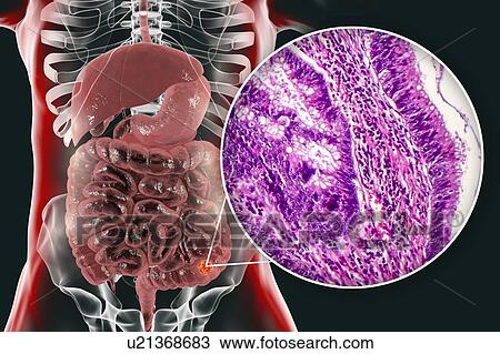 Stock Image - Colon cancer, composite image. Fotosearch