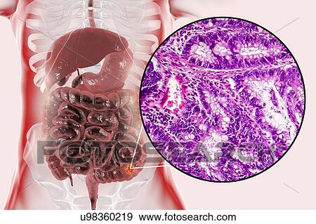 Stock Photo - Colon cancer, composite image. Fotosearch