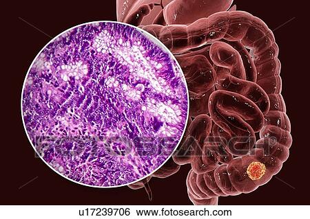 Stock Photograph - Colon cancer, composite image. Fotosearch