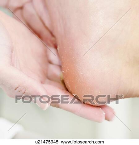 Stock Photography - Cracked heel treatment. Fotosearch