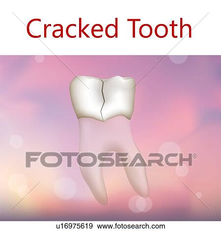 Stock Photo - Cracked tooth, illustration. Fotosearch