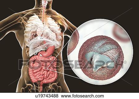Stock Photo - Cryptosporidium protozoan intestinal parasite, illustration. Fotosearch