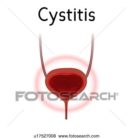 Stock Photo - Cystitis, illustration. Fotosearch