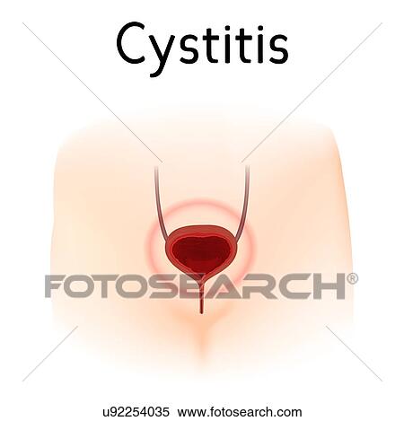 Stock Photography - Cystitis, illustration. Fotosearch