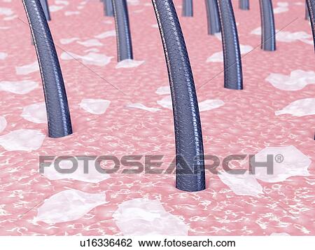Stock Image - Dandruff, illustration. Fotosearch