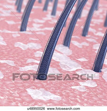 Dandruff, illustration View Large Photo Image Stock Photograph - Dandruff, illustration. Fotosearch