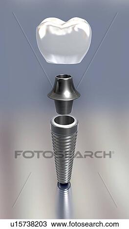 Stock Image - Dental implant, illustration. Fotosearch