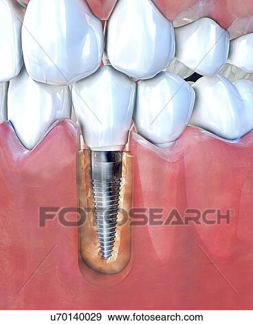 Stock Photo - Dental implant, illustration. Fotosearch