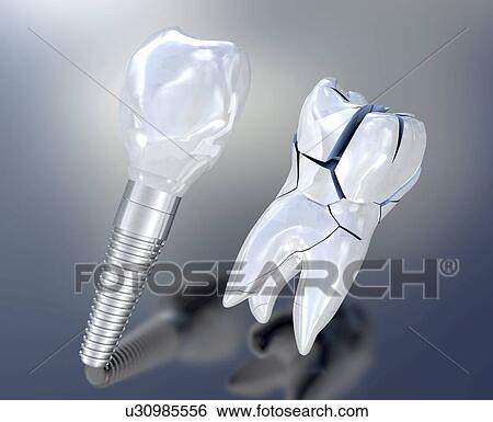 Dental implant, illustration View Large Photo Image Stock Photograph - Dental implant, illustration. Fotosearch