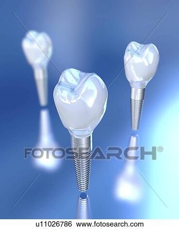 Stock Photograph - Dental implants, illustration. Fotosearch